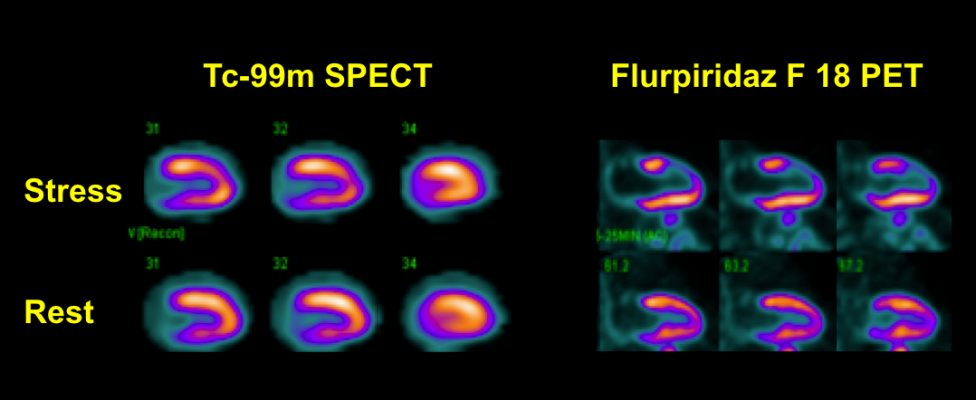 Flurpiridaz F-18 May Expand PET for Myocardial Perfusion Imaging